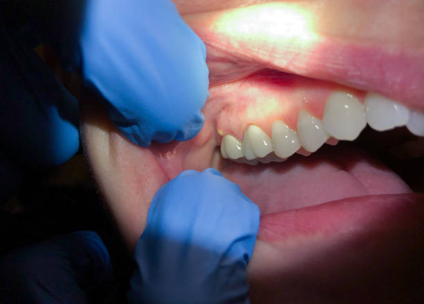Best Emergency Gum Pain Relief  in Sackets Harbor, NY